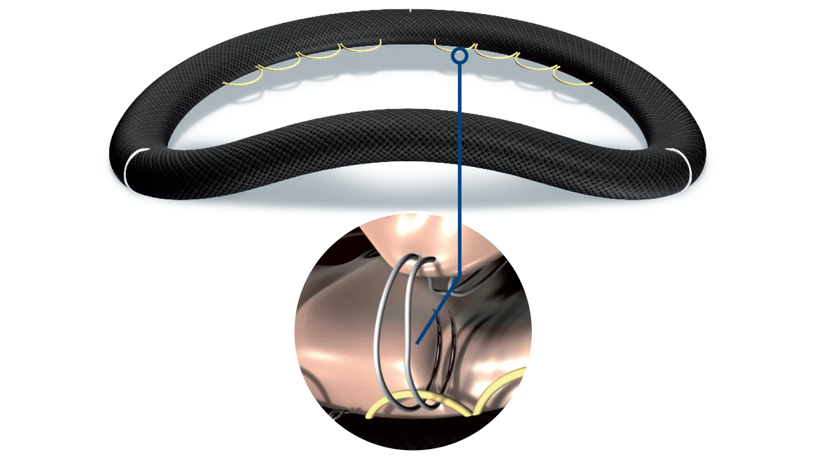 Memo 4D mitral valve repair rechord system facilitating sizing and knotting