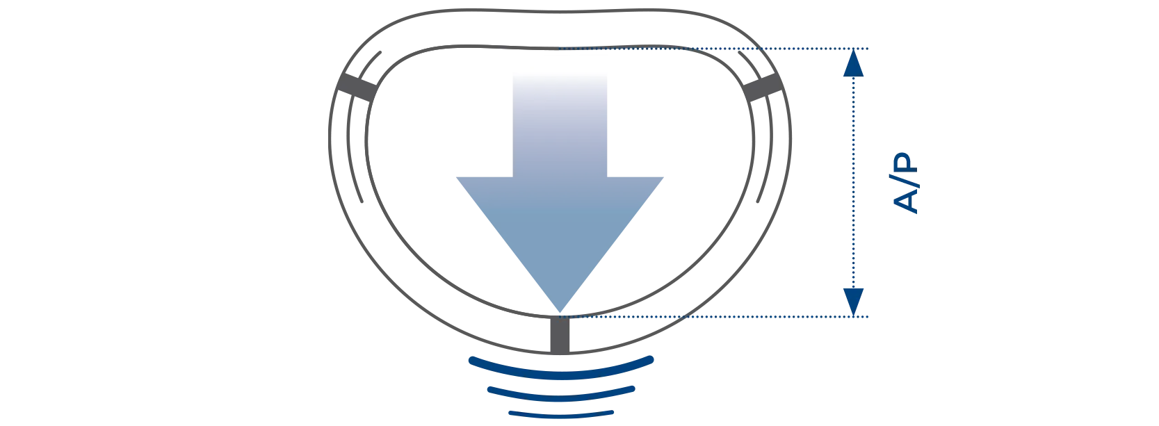 Memo 4D mitral valve ring educing the risk of systolic anterior motion