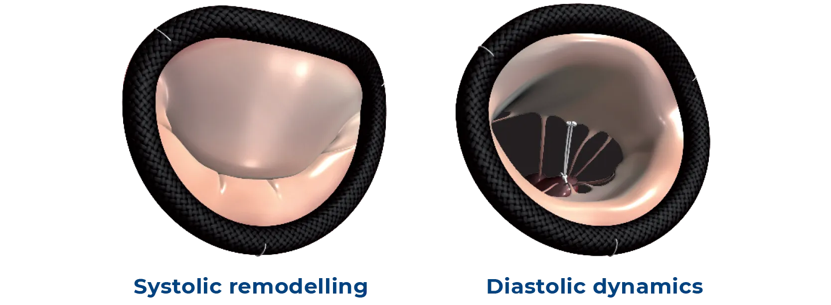 Mitral vailve reapir physiological three-dimensional motion: systolic remodelling and diastolic dynamics