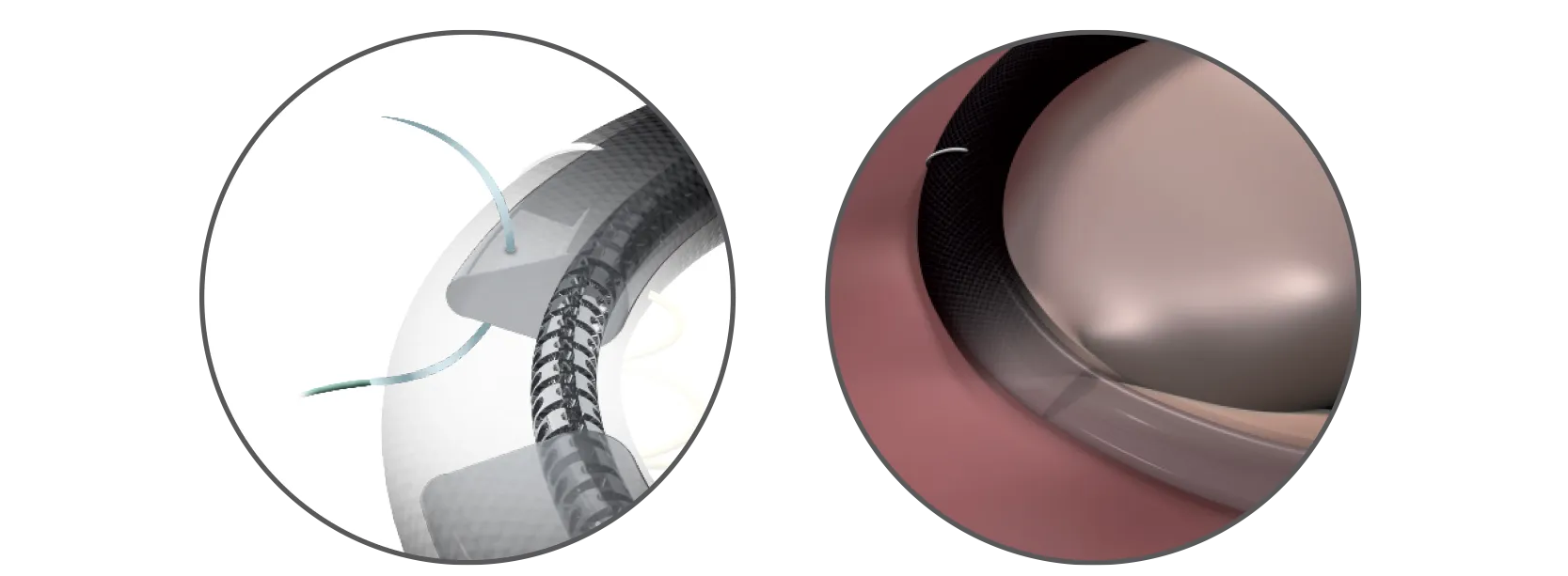Memo 4D mitral valve repair slim fit, optimally fit to the patient annulus